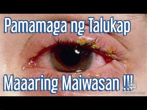 namamaga ang mata english|Pamamaga ng mata in English .